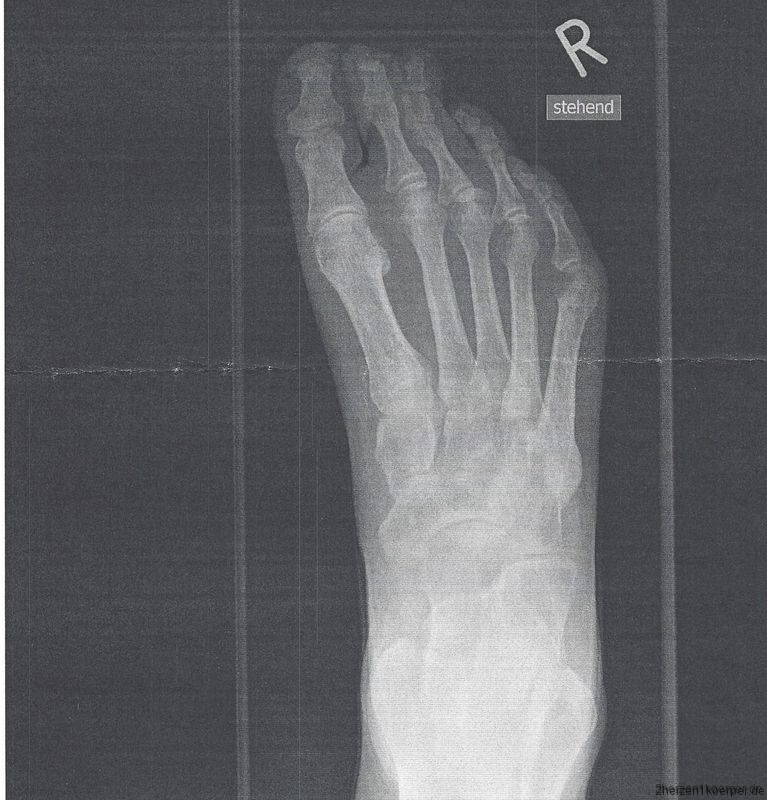 Mein Fuß, ein Opfer der Herztransplantation