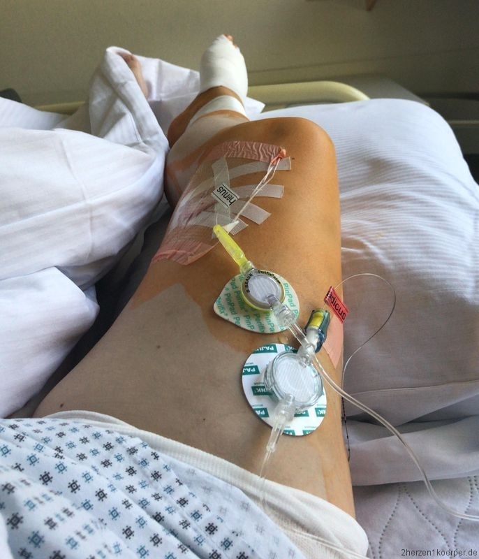 Mein Fuß, zwei Operationen später - 2Herzen1Körper